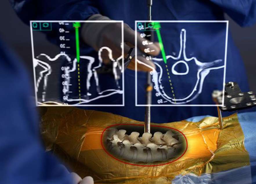 VB Spine宣布收购Augmedics的AR脊柱手术导航技术